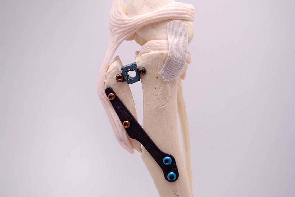 Image of a TTA plate on a bone model